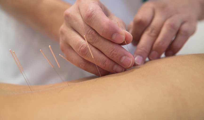 ACUPUNCTURE